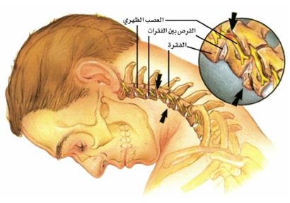 مقالــــة علميــــة للتدريسيــــة م.م ايمـــان وهاب كاظـــم بعنـــوان :- الآم الرقبــة عند الشبـــاب