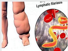 مقالــــة علميــــة للتدريسيــــة م.م ايمـــان وهاب كاظـــم بعنـــوان :- مرض الفلاريا أو داء الفيل