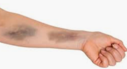 مقالة علمية للدكتورة م.د افتخار مطر باقر بعنوان (ظهور الكدمات المفاجئة في الجسم)