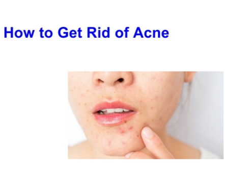  تم نشر مقالة علمية للدكتورة (رشا فاضل عبيد ) بعنوان How to Get Rid of Acne