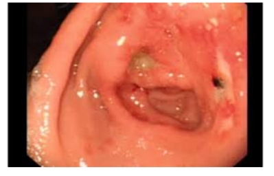 تم نشر مقالة علمية للتدريسيه في قسم تقنيات التخدير الدكتورة رواء ماجد محمد بعنوانStomach Ulcers and What You Can Do About Them 