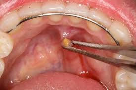 مقالة علمية للتدريسي م.م.محمد فارس بعنوان Salivary gland stone
