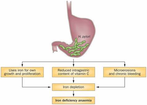 نشر مقالة علمية للتدريسي في قسم تقنيات التخدير (م.م محمد عبد الزهرة صعصاع) بعنوان Association of Chronic Helicobacter pylori infection with Iron  Deficiency Anemia 