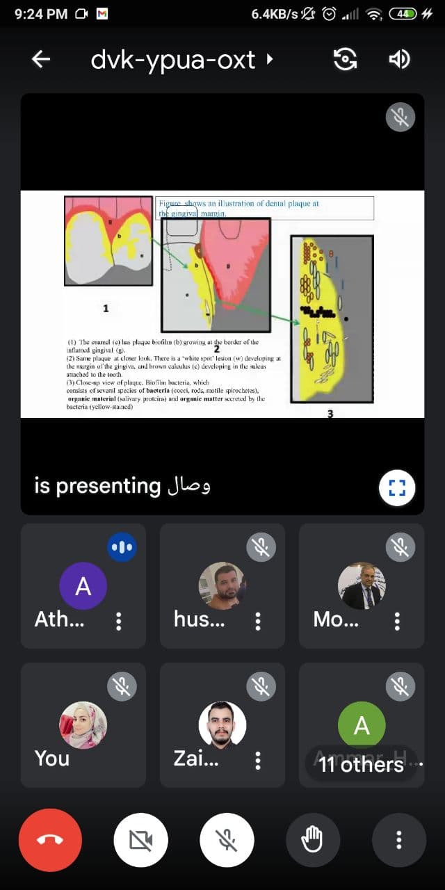 ندوه علمية ألكترونيه للدكتوره عذراء يحيى محمد الحجازي بعنوان (Etiology and pathogenesis of dental caries)