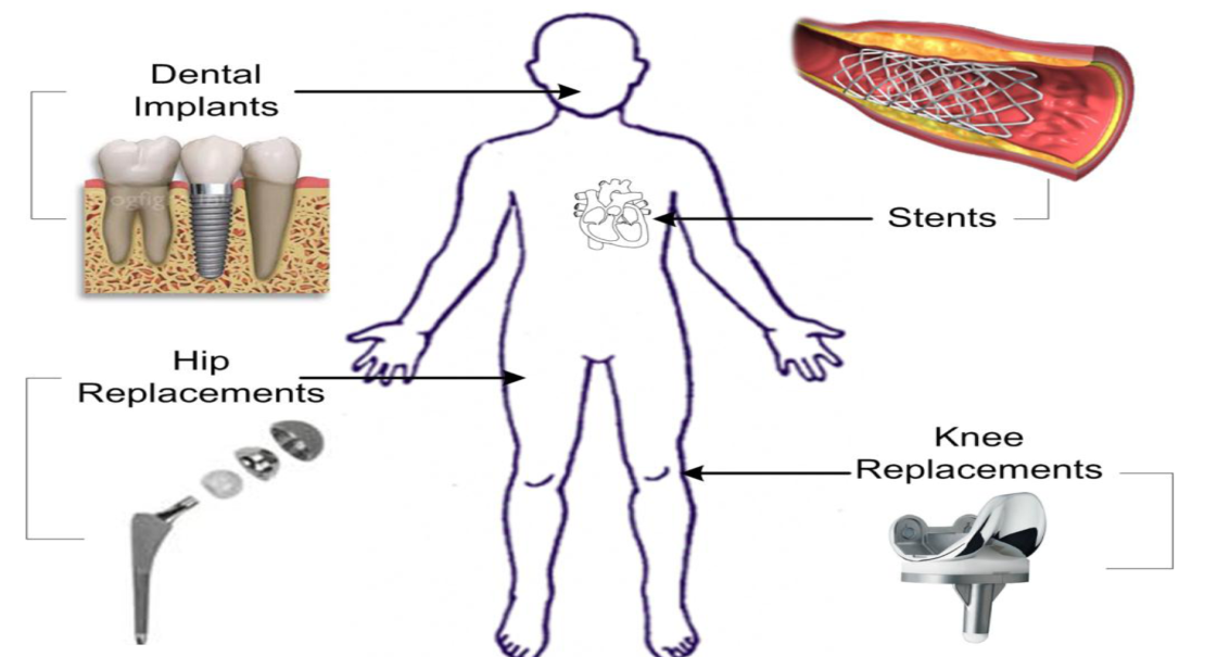 مقالة للتدريسية (( م.م. قبس خالد ناجي )) بعنوان ((تحسين الخواص السطحية لسبيكة التيتانيوم المستخدمة في التطبيقات الطبية))