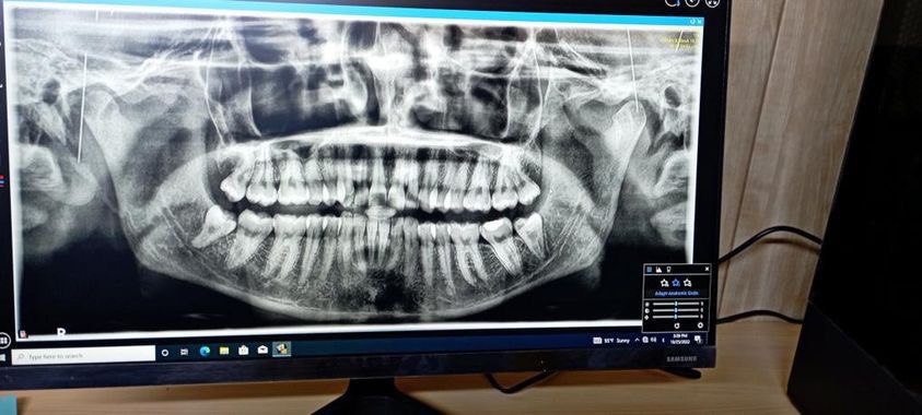 عملية قلع جراحي لسن العقل في عيادة جراحة الأسنان 