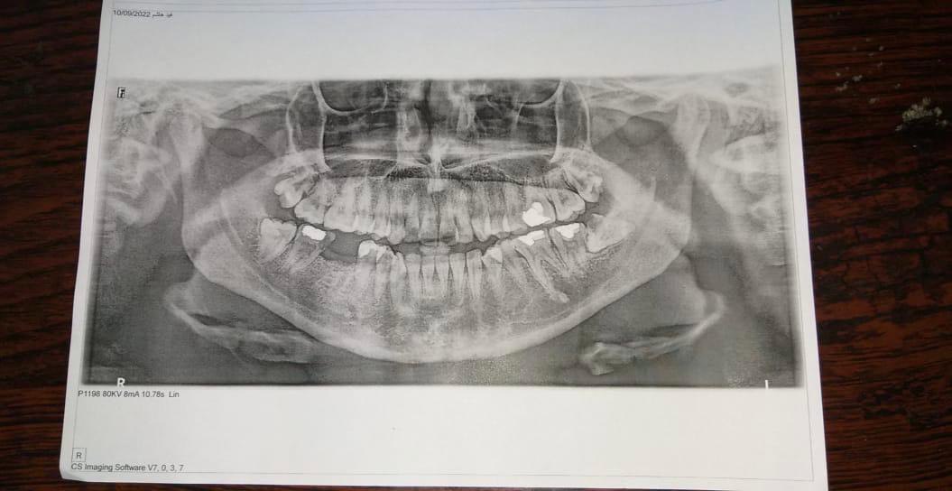 Performing surgical extractions in a dental surgery clinic