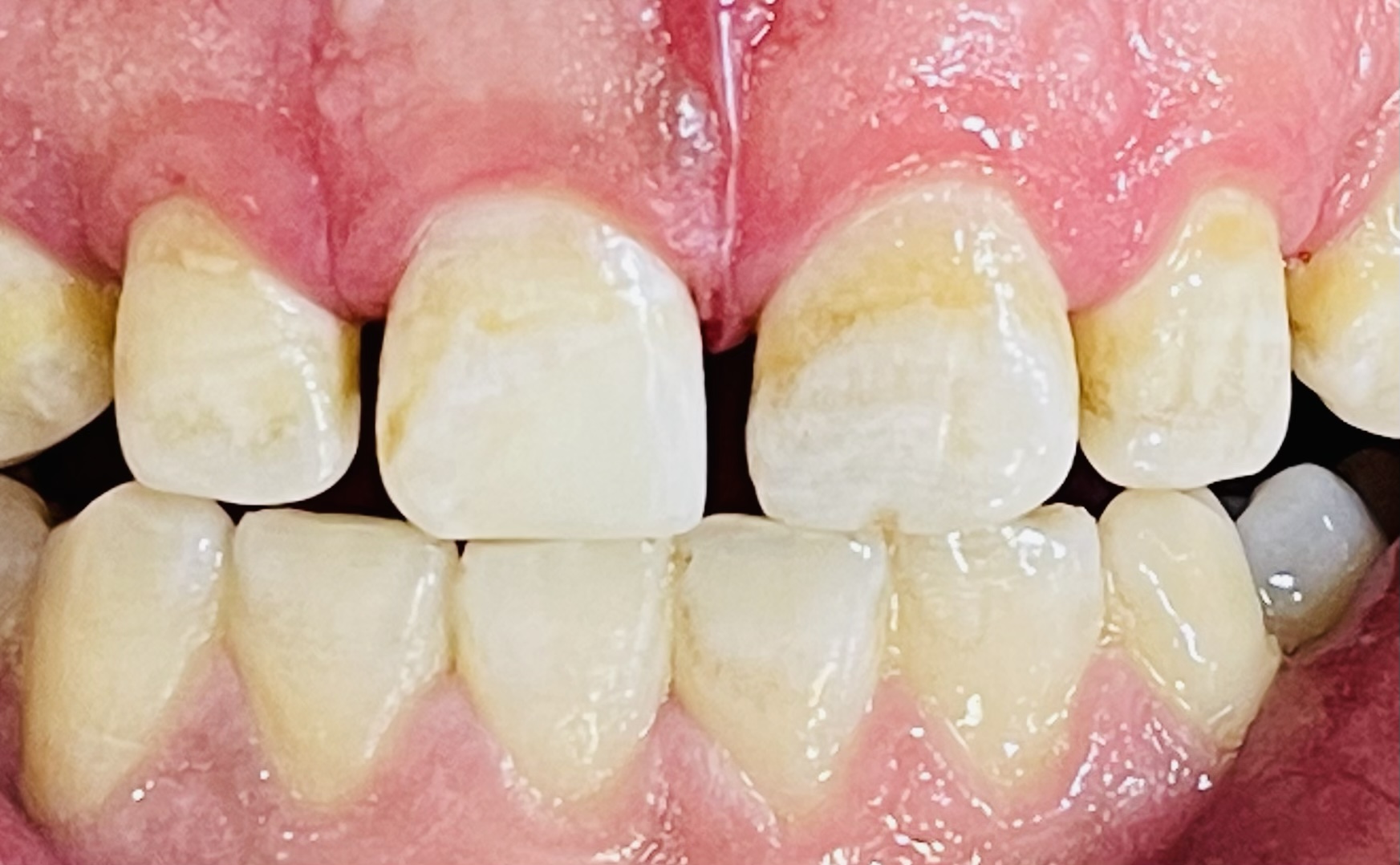 أجراء حشوات امامية مميزة في عيادة معالجة الأسنان 