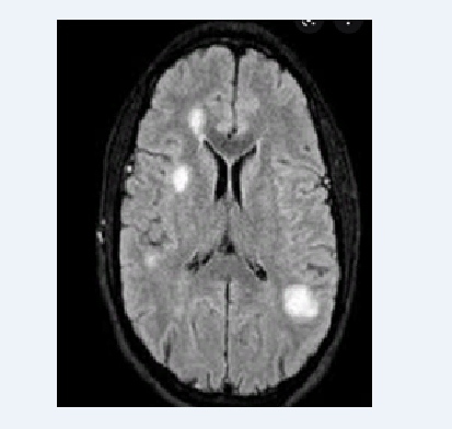 Bacterial Meningitis After Intrapartum Spinal Anesthesia