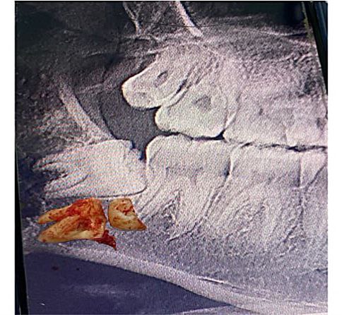 أجراء عملية قلع سن العقل لمريض في عيادة جراحة الفم