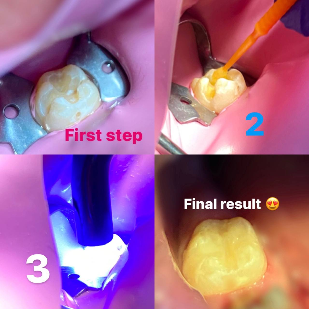 أجراء حشوة ضوئية composite resin  لمريض في عيادة معالجة الأسنان 