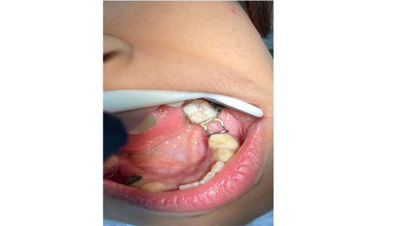 جانب من عمل SPACE MANTAINER لمريض في عيادة طب أسنان الاطفال .