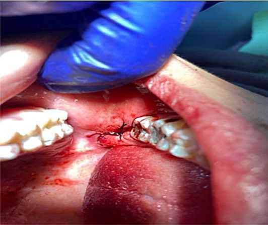 أجراء عملية قلع سن مطمور بالفك السفلي لمريض زار عيادة جراحة الفم 