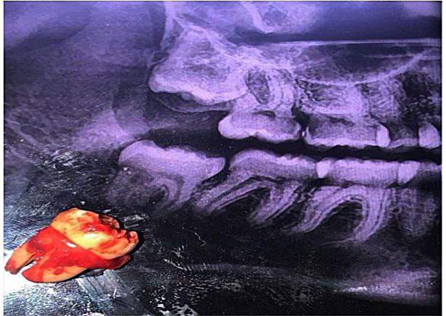 أجراء عملية قلع سن مطمور لمريض في عيادة جراحة الفم