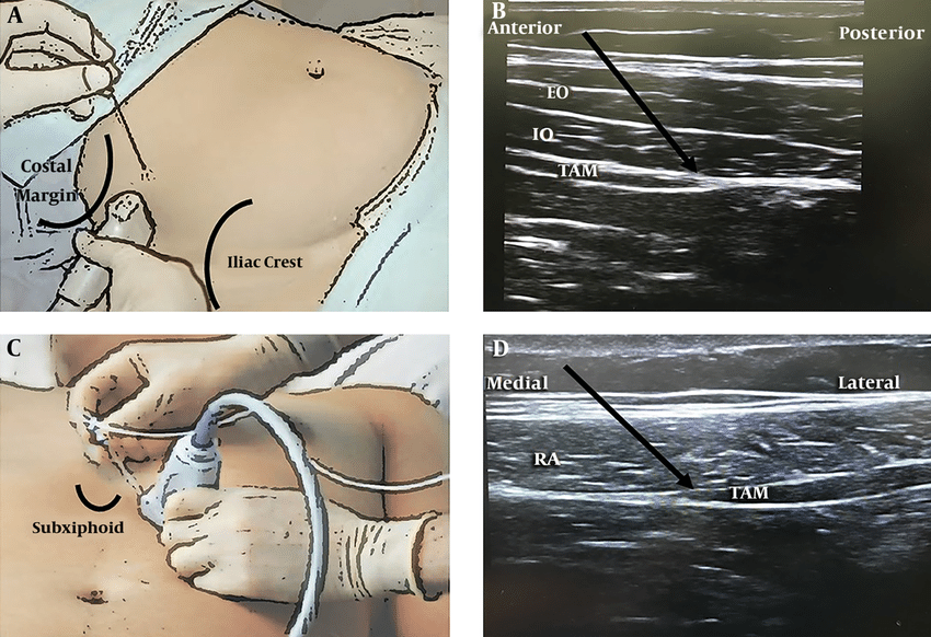 Trans abdominal  plane block