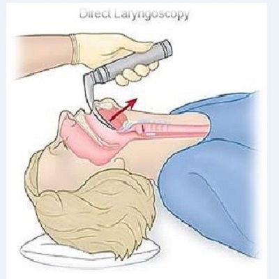 Direct laryngoscopy