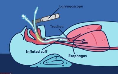 Post general anesthesia sore throat