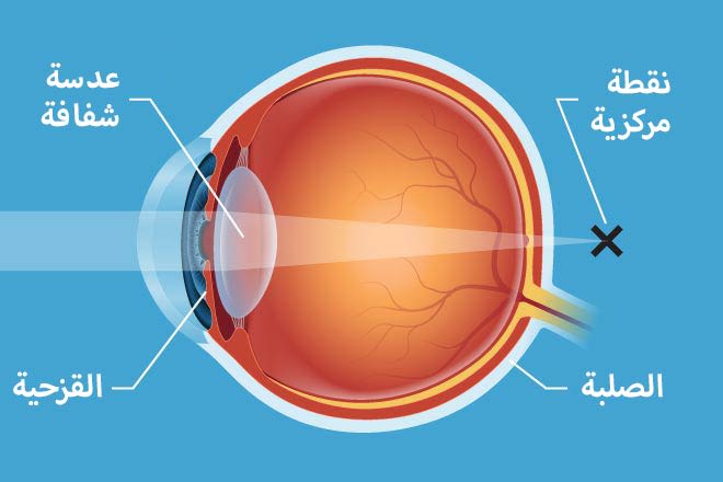 قصر النظر مقالة علمية للتدريسية م.م رهام خالد كريم .