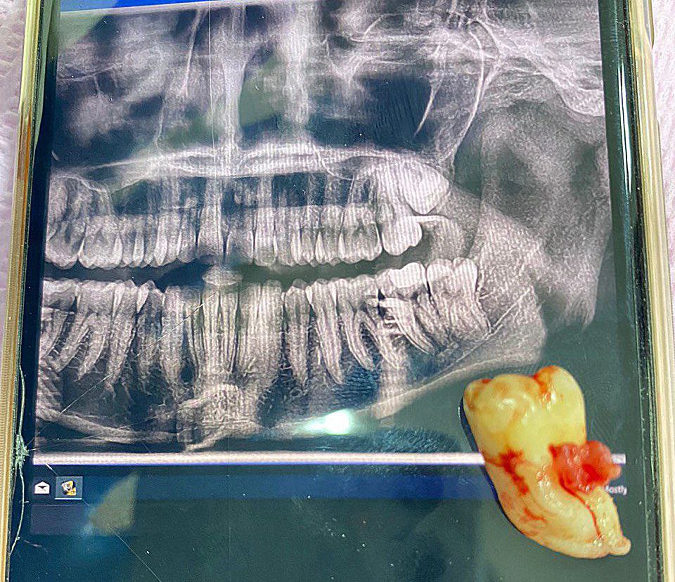 Performing a surgical extraction for a patient in an oral surgery clinic