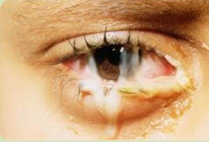 A scientific article by the teaching assistant teacher, Marwan Hisham Muhammad, entitled (Ocular inflammation)