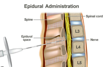 WHAT ARE THE RISKS OF SPINAL BLOCK AND EPIDURAL ANESTHESIA?