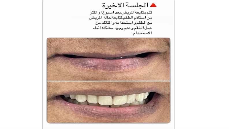 تميز وأبداع الطالبة زهراء زمان في عمل طقم لمريض فاقد لاسنانه 