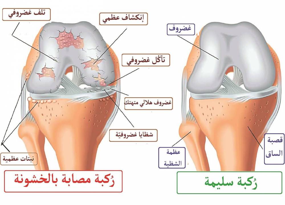 ماهيه خشونة المفاصل و ما هي االامراض المحتملة لحقن علاج خشونة المفاصل مقالة علمية للست نور فراس محمد رضا