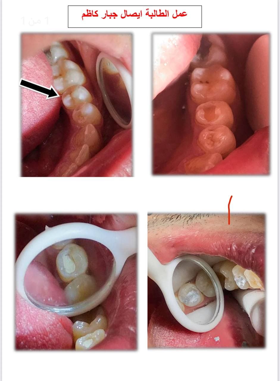 جانب من أبداع الطالبه ايصال جبار كاظم في عمل حشوة ضوئيه لمريض 