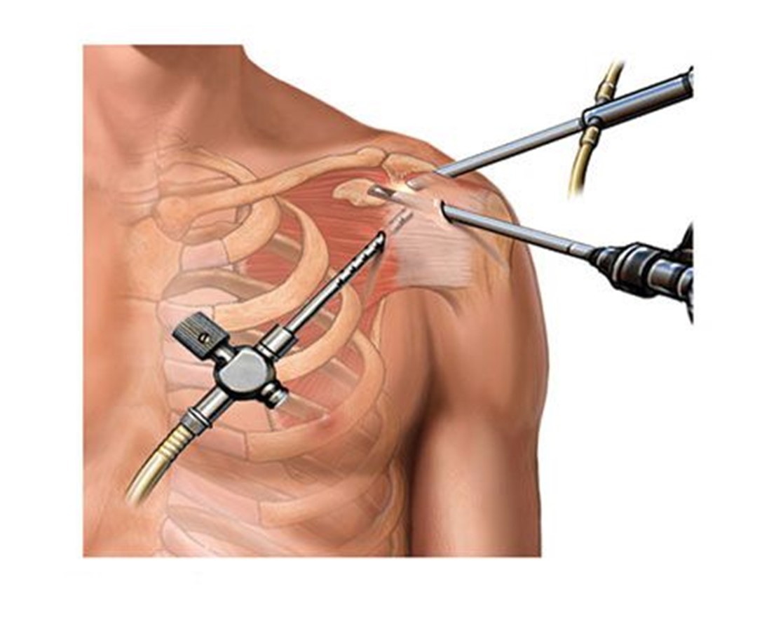 Advances in Regional Anesthesia For Shoulder Surgery