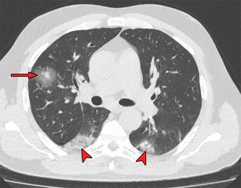 Role CT scan in COVID -19pneumonia د. عفراء جاسم 