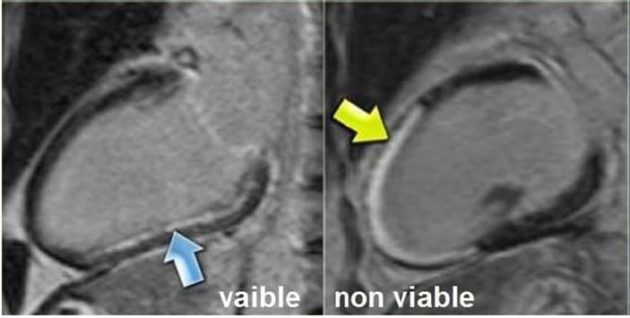 Role of Contrast Enhanced Cardiac Magnetic Resonance Imaging in Assessment of Ischemic Heart Disease   م.م حسين عايد حسين
