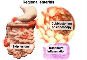An article by (MSc Ata'a Khalil Hussein) entitled (CROHN'S DISEASE (CD))