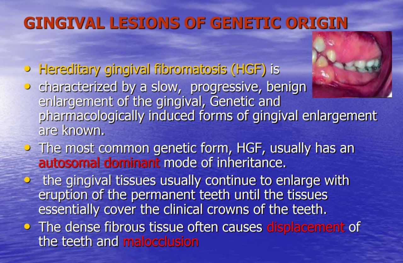 قسم طب الأسنان يعقد ندوه علمية ألكترونيه بعنوان " Gingivitis and periodontal diseases  in children "