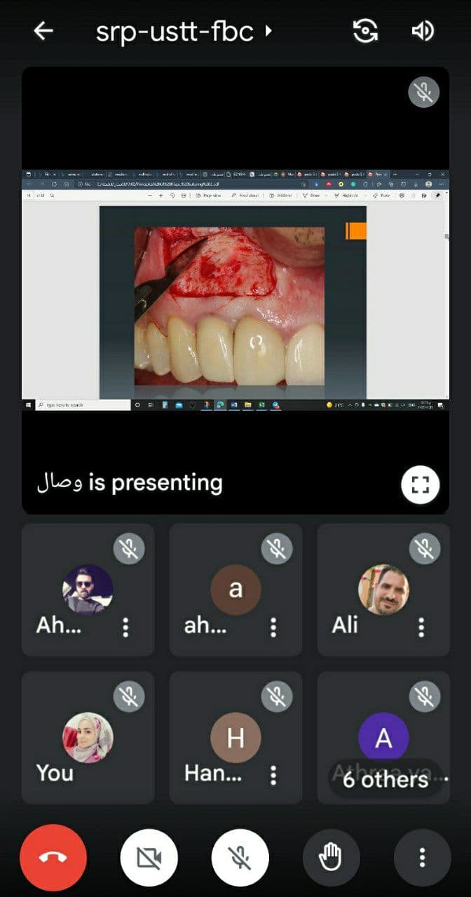 قسم طب الأسنان يعقد ندوه علمية ألكترونيه بعنوان "Principles of, incisions Flaps & Suturing"