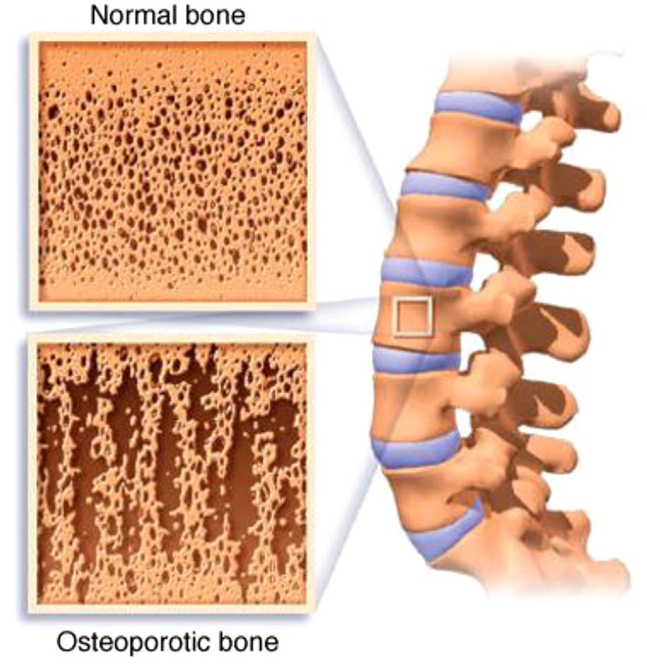 Osteoporosis (scientific article for M.S.C.Doaa Nassr Alhosainy)