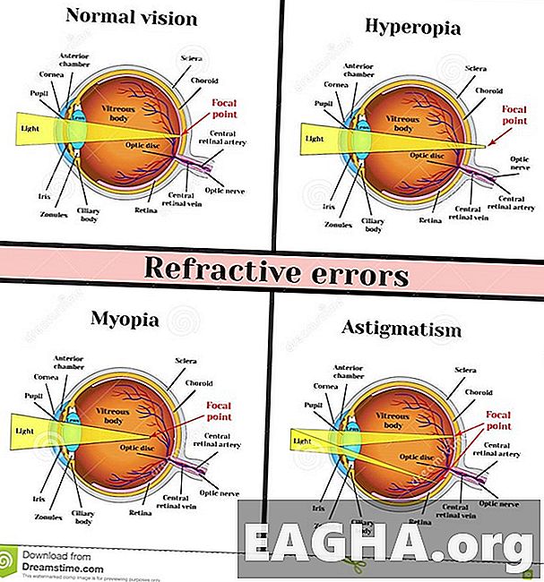 مقاله علمية للاستاذة زينب احمد عباس: علاج الاخطاء الانكسارية في العين