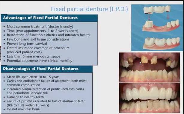 Holding an awareness lecture on therapeutic methods to replace missing teeth within the goals of sustainable development