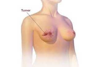 Breast cancer Scientific article Dr.Rawaa Majid Mohammed 