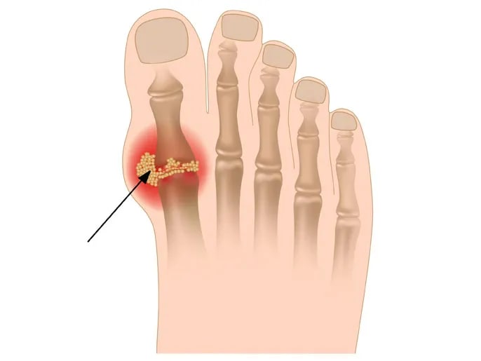 مرض النقرس و كيفية تشخيصة و طرق الوقايه منه ندوة علميه للتدريسيه م.م دعاء نصر وهاب