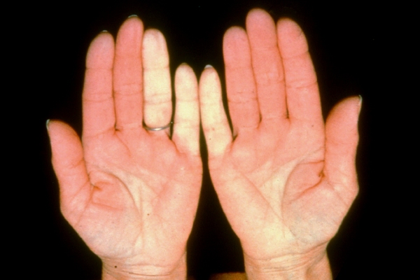 Raynaud’s disease  الفيزياوي كرار حيدر عبد الحسين