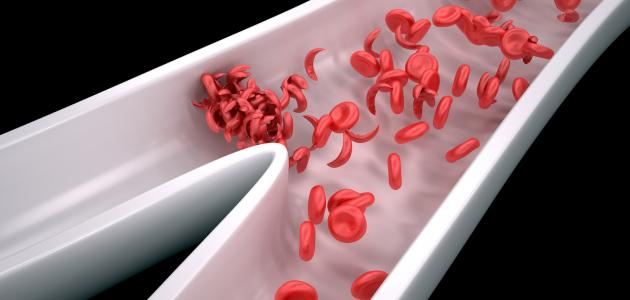 فقر الدم المنجلي  م.م زهراء سامي