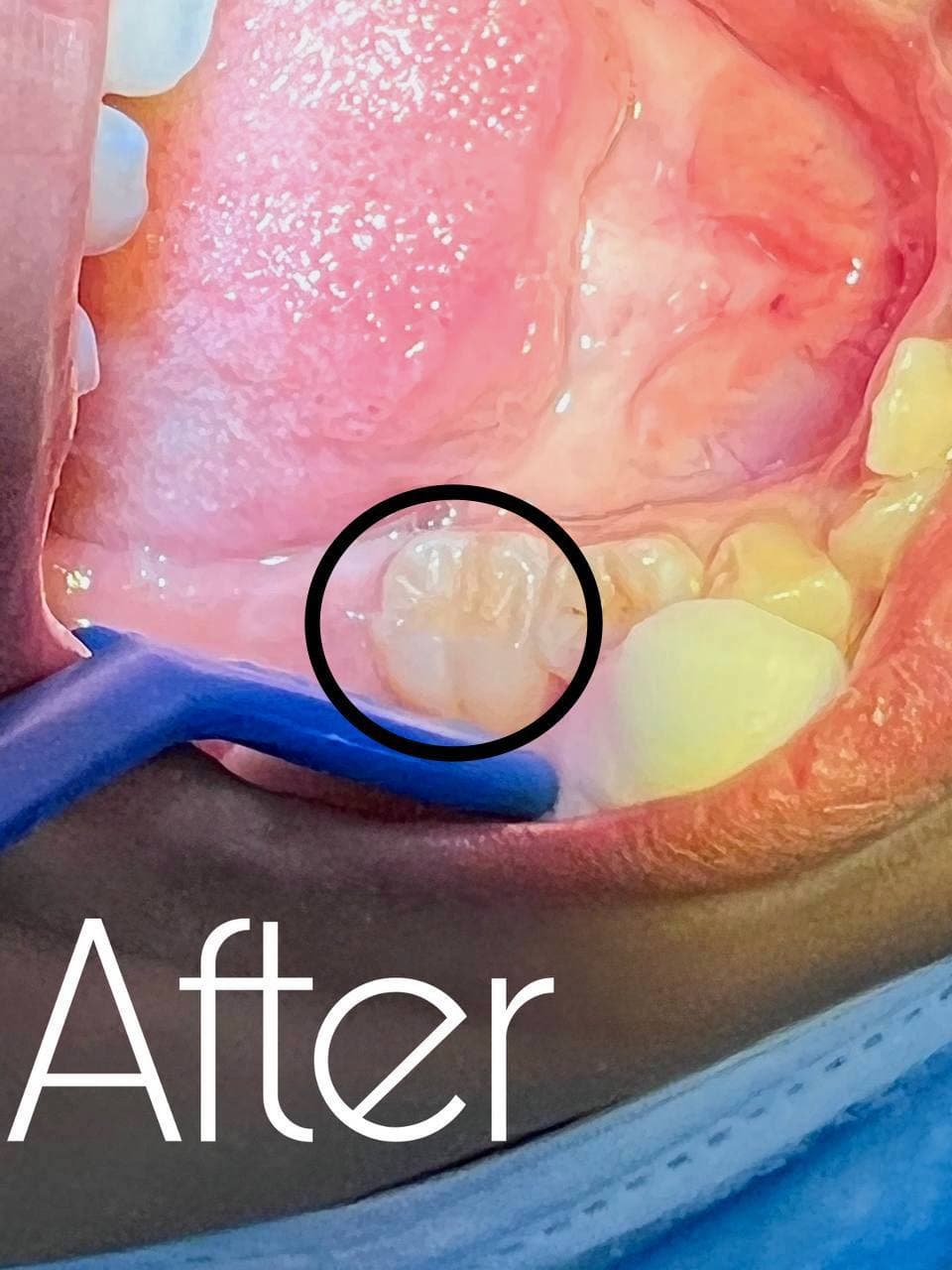 أجراء حشوة ضوئية في عيادات طب الأسنان في كلية المستقبل الجامعة 