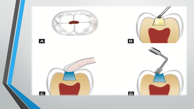 The Department of Dentistry holds a scientific seminar entitled (glass fillings)