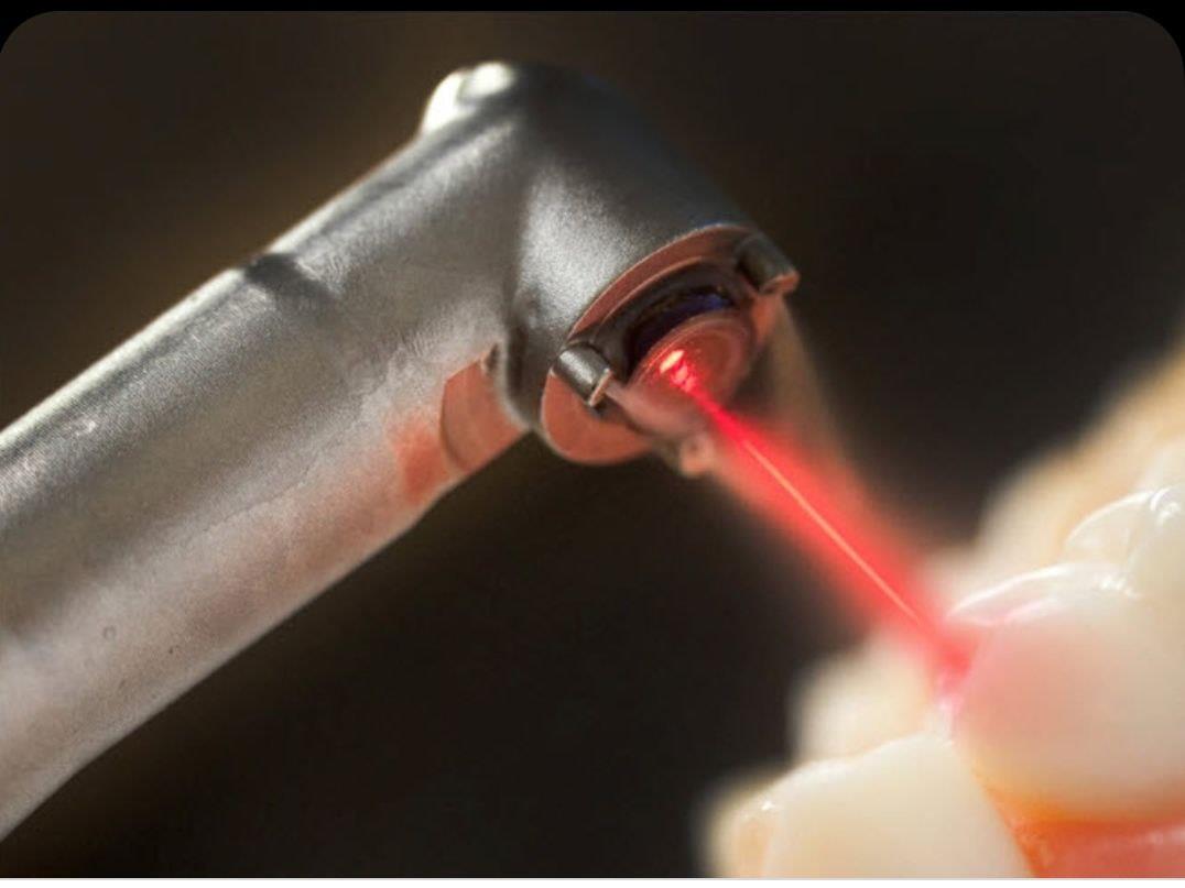 علاج تسوس الأسنان باستخدام الليزر مقالة علمية للتدريسية م.م هاله محمد عزيز