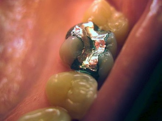 An Article entitled ( How are dental amalgams made?)