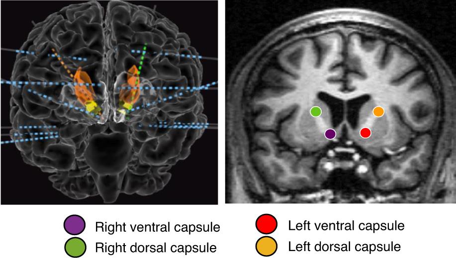 علاج الأمراض العقلية بمحاكاة الدماغ