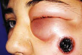 الجمرة الخبيثة  ا.م.د غيداء رحيم لطيف