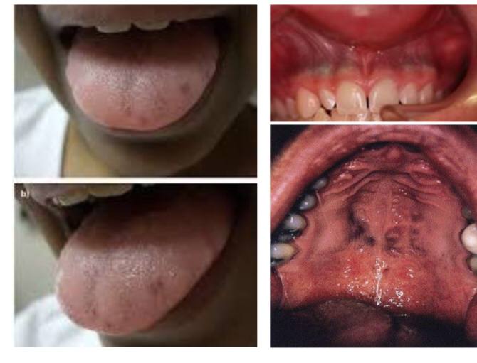 مقال علمي جديد للدكتورة هنادي هادي بعنوان Medication-induced oral hyperpigmentation (MIOH)