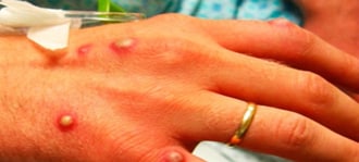 مقالة علمية للمعيدة ساره عباس بعنوان جدري القرده