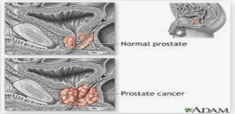 ?Coffee: Good or Bad for the Prostate